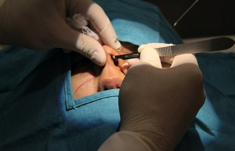 Técnica quirúrgica de septoplastia